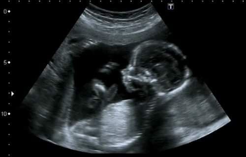Create meme: fetus at 24 weeks of pregnancy ultrasound, ultrasound of 16 weeks of pregnancy, ultrasound 16 weeks