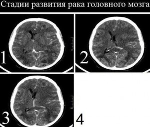 Создать мем: метастазы головного мозга кт кт, контузионные очаги головного мозга кт, контузионный очаг головного мозга кт