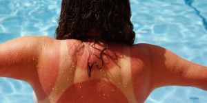 Create meme: burn in the sun, beach sun burn, sunburn and butter