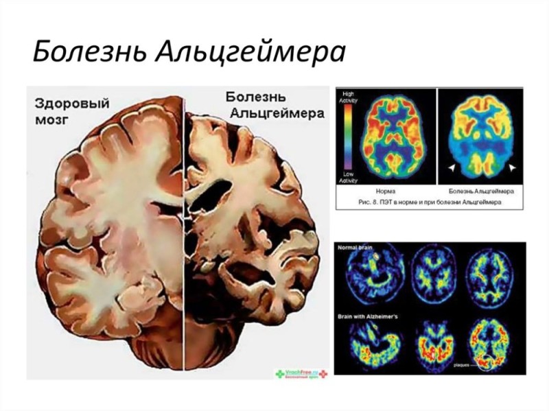 Создать мем: альцгеймер болезнь, признаки болезни альцгеймера, мозг человека с болезнью альцгеймера