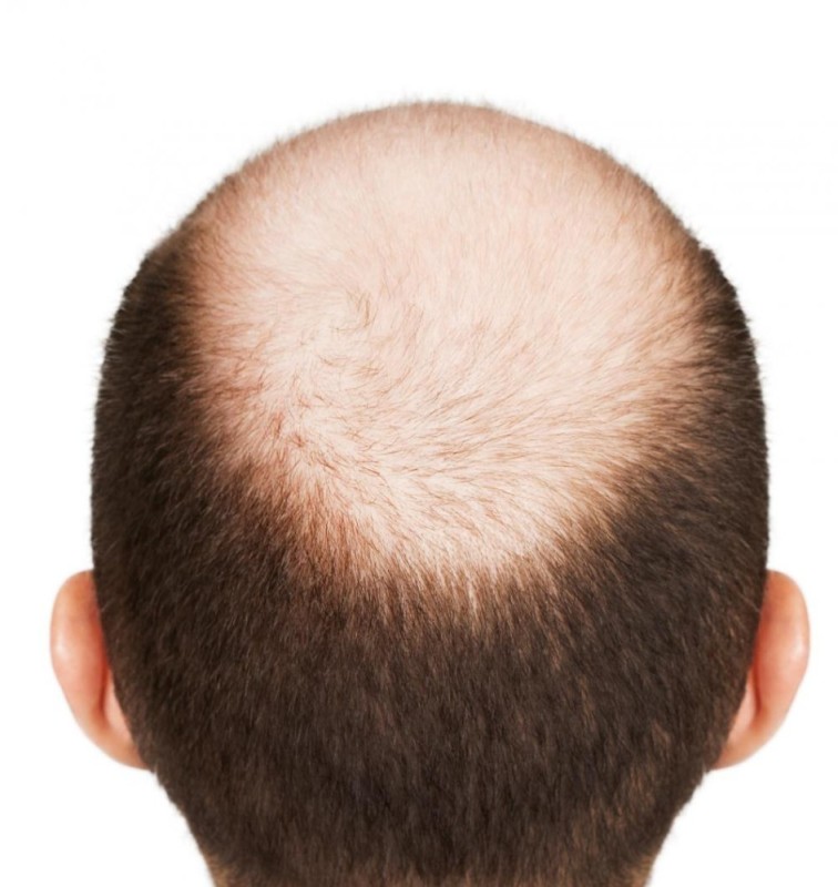 Create meme: bald spot on top, alopecia, bald spot on the head