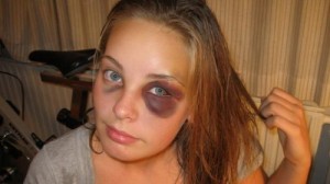 Create meme: bruise, black eyes, face