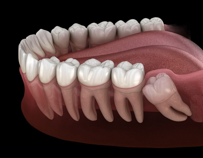 Create meme: wisdom tooth (3rd molar, figure eight), small molars, teeth 