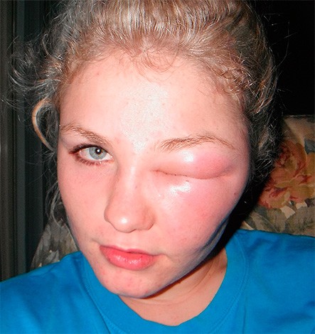 Create meme: a mosquito bit my eyelid, after a bee sting, allergic swelling of the face