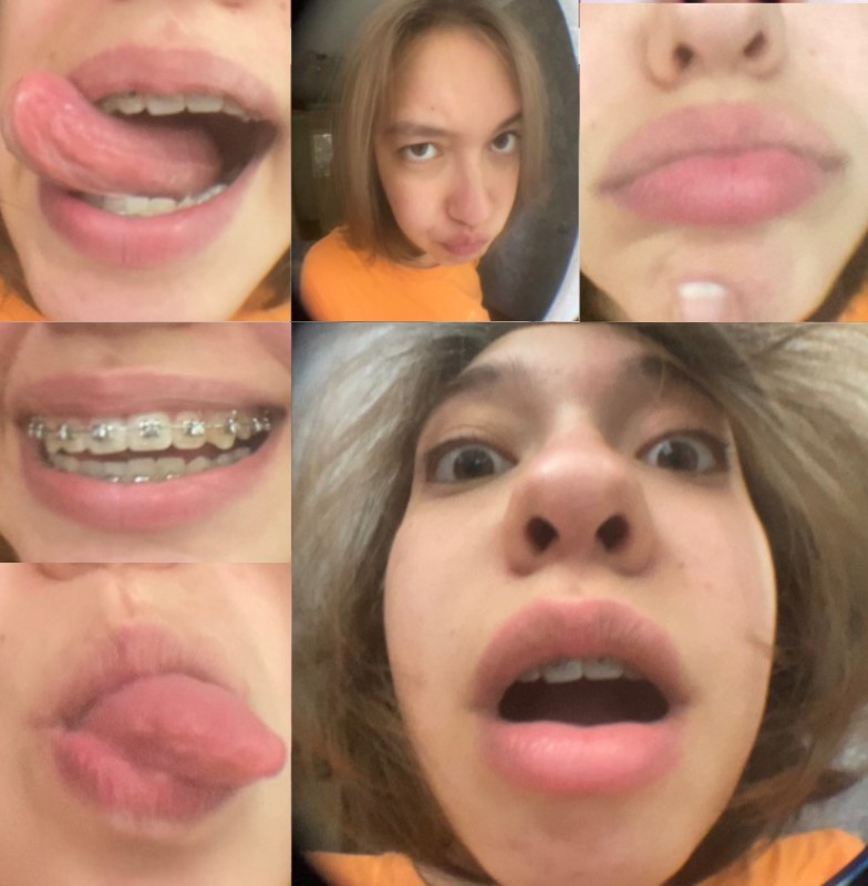 Create meme: braces results, lips , metal braces